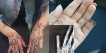 Investigan a policías que amputaron dedo a mujer durante su detención