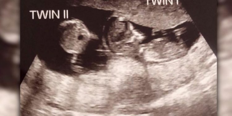 Así lucían los gemelos con diferente tiempo de gestación