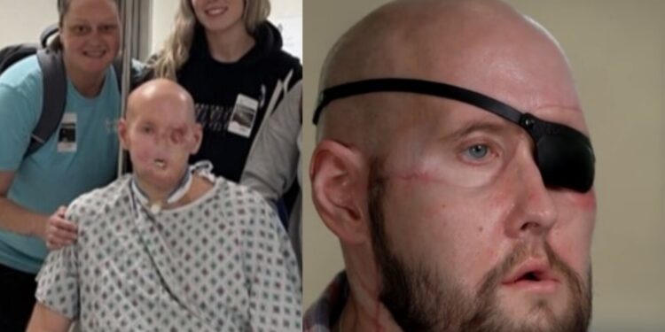 ¡Impactante! Conoce la historia de Aaron James, la primera persona en el mundo en recibir un trasplante de cara