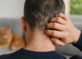 ¿Es Caspa o Psoriasis Capilar?